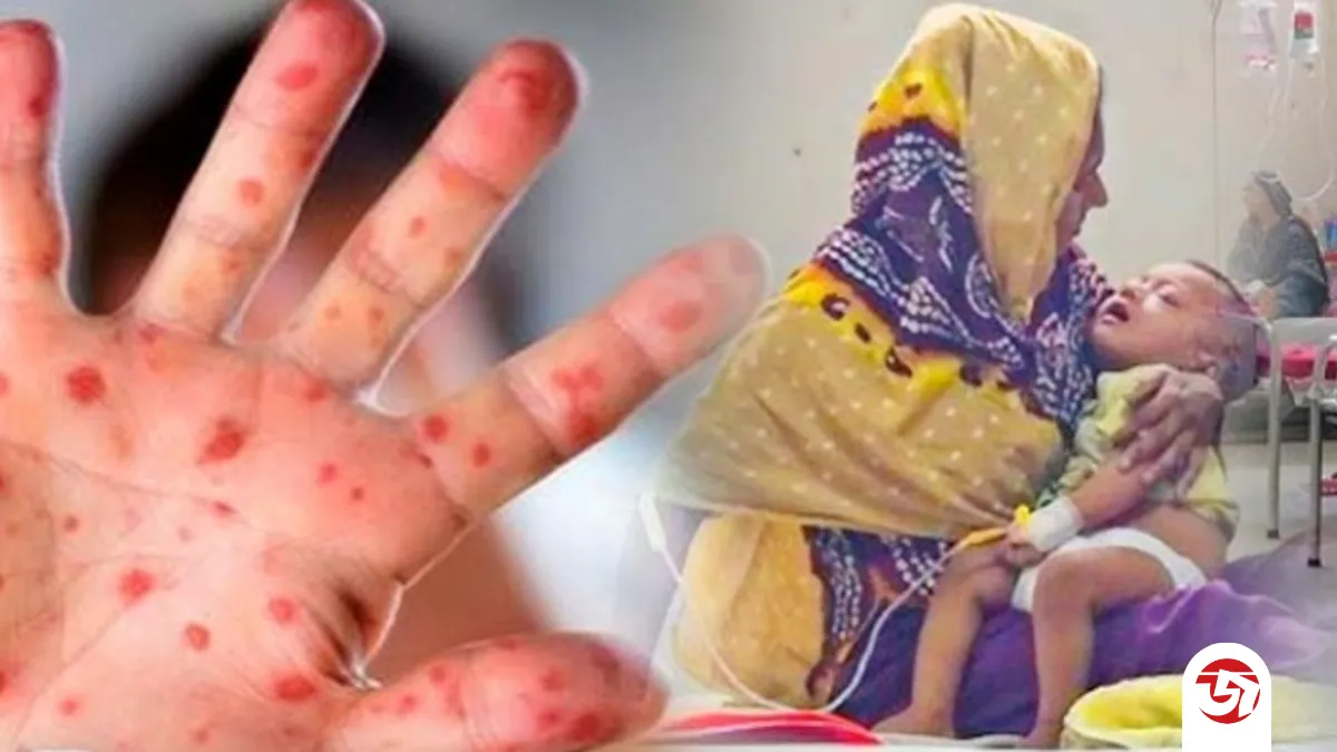 বরিশালে হাম উপসর্গে আরও এক শিশুর মৃত্যু