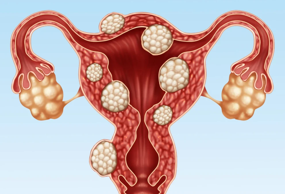 পিরিয়ডের সময় ব্যথা বা ভারী রক্তপাত? হতে পারে 'ফাইব্রয়েড'-এর নীরব সতর্কবার্তা!