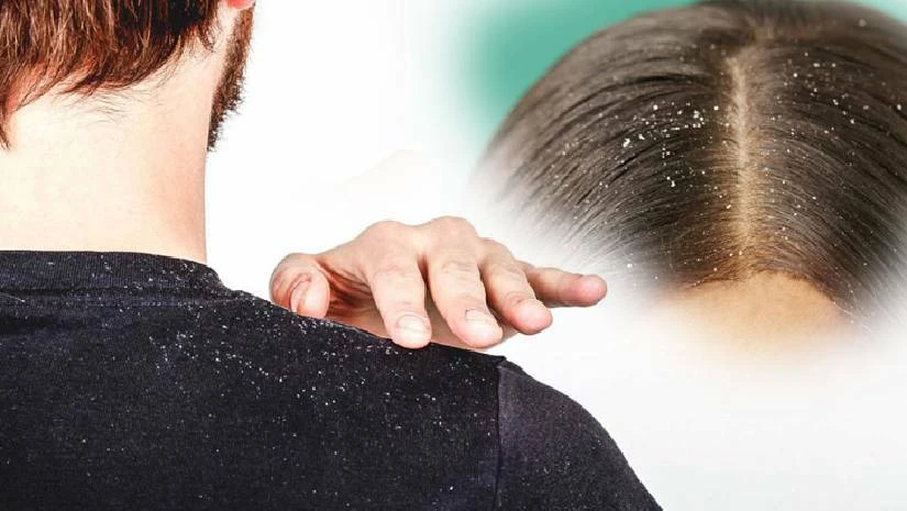 খুশকি দূর করার ঘরোয়া ৯ উপায়