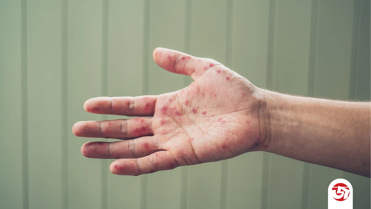 বরিশালে হামের উপসর্গ নিয়ে দুই শিশুর মৃত্যু