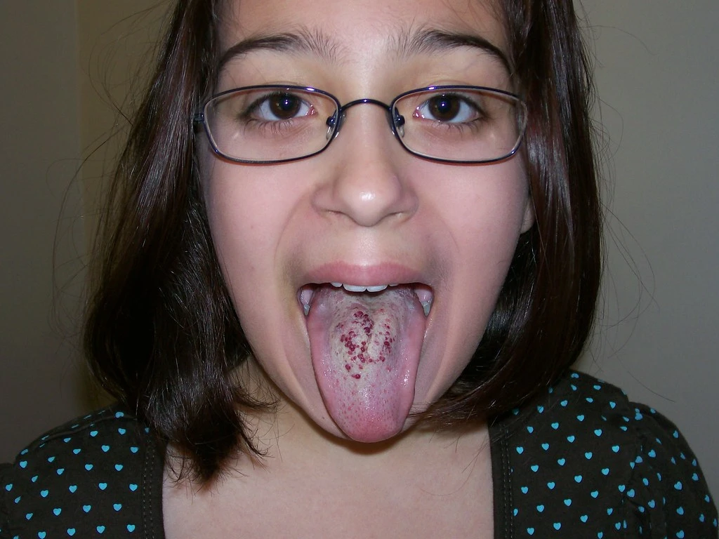 জিহ্বায় লুকানো ঝুঁকি! টাং হেম্যানজিওমার কারণ, ঝুঁকি ও সতর্কবার্তা