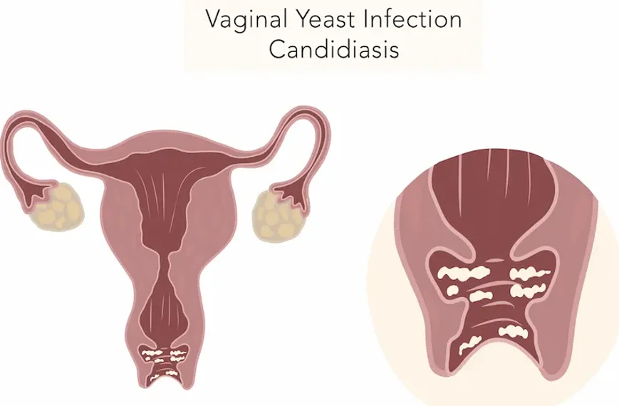 অসহ্য চুলকানি ও অস্বস্তি?ভেজাইনাল ইস্ট ইনফেকশন চেনার  লক্ষণ ও  প্রতিকার!