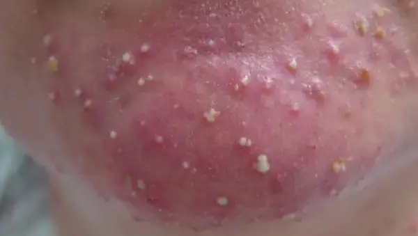 হরমোনের ওঠানামা আর ত্বকের রহস্য, কেন পরিবর্তন হয়, আর কীভাবে যত্ন নেবেন!!