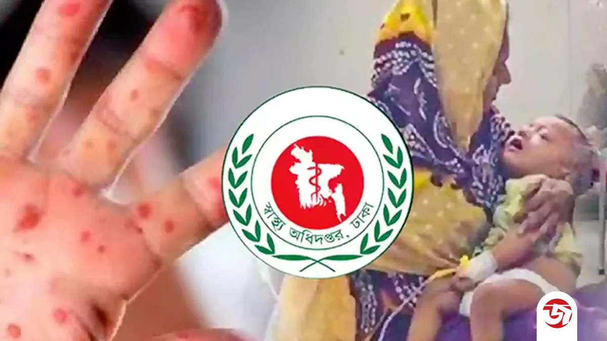 হামের উপসর্গে আরও ৮ শিশুর মৃত্যু, প্রাণহানি বেড়ে ৫৮৩