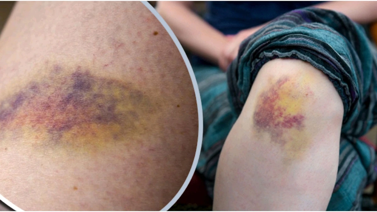 সামান্য আঘাতেই ত্বকে কালশিটে? হতে পারে আপনার শরীরের কোনো গুপ্ত রোগের সংকেত!