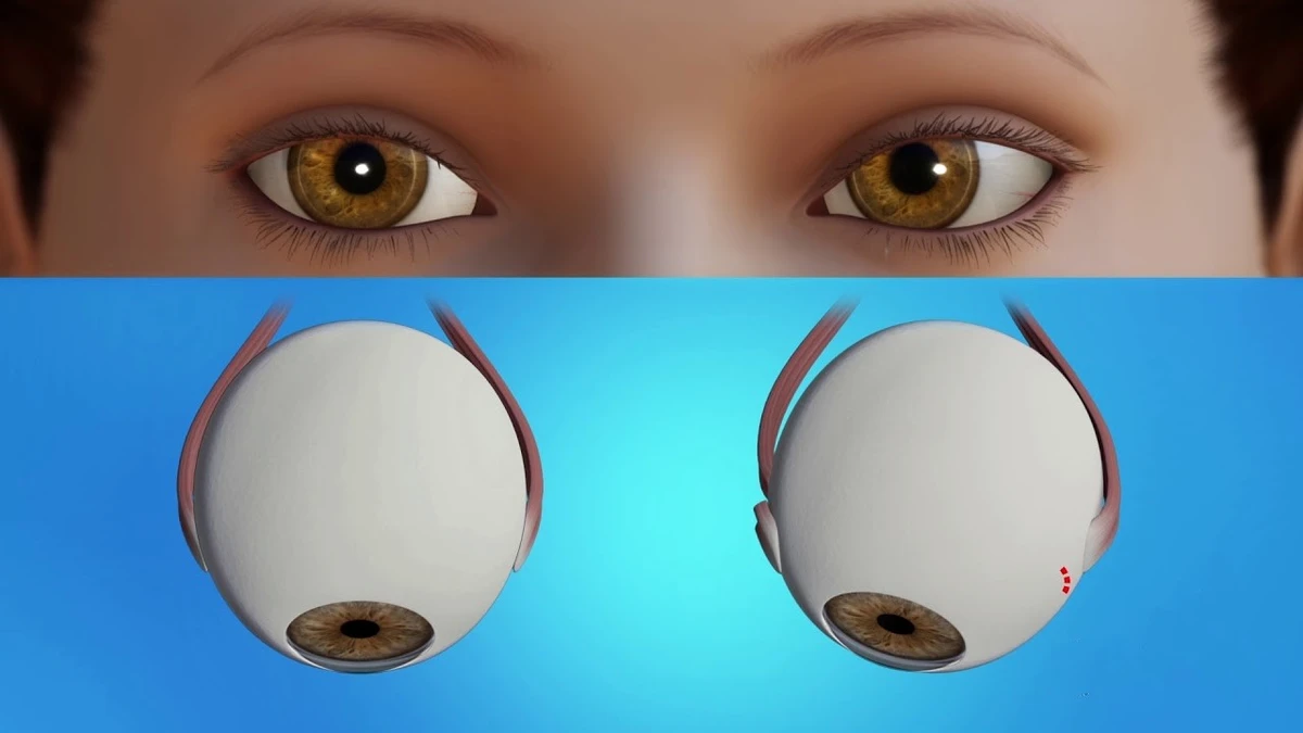 লেজি আই ধরা পড়ার সেরা সময় এখনই, আট বছরের আগেই চিকিৎসা জরুরি