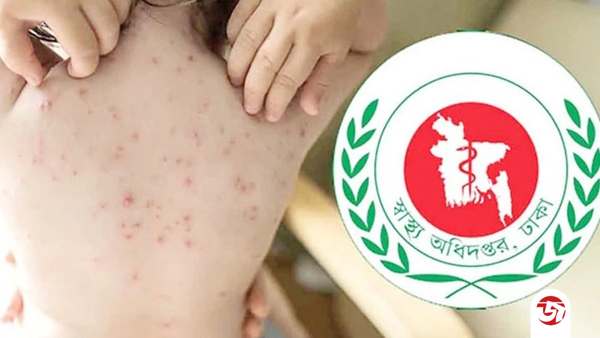 দেশে হাম ও হাম সন্দেহে শিশু মৃত্যু আড়াইশ ছাড়াল