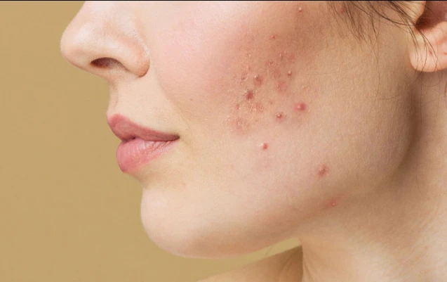 ২৪ ঘণ্টায় ব্রণ কমাতে কার্যকর ৭ উপায়, জানালেন ত্বক বিশেষজ্ঞরা